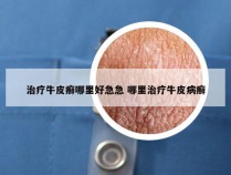 治疗牛皮癣哪里好急急 哪里治疗牛皮病癣