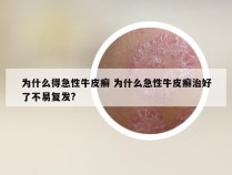 为什么得急性牛皮癣 为什么急性牛皮癣治好了不易复发?