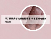 得了银屑病都吃哪些维生素 有银屑病吃什么维生素
