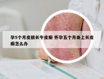 孕5个月皮肤长牛皮癣 怀孕五个月身上长皮癣怎么办