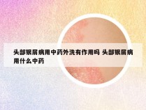 头部银屑病用中药外洗有作用吗 头部银屑病用什么中药