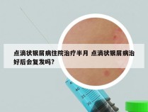 点滴状银屑病住院治疗半月 点滴状银屑病治好后会复发吗?
