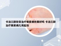 卡泊三醇软膏治疗银屑病效果好吗 卡泊三醇治疗银屑病几周起效