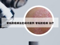 掌跖脓疱病治愈成功案例 掌跖脓疱病 治疗