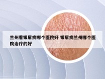 兰州看银屑病哪个医院好 银屑病兰州哪个医院治疗的好