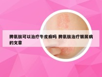 脾氨肽可以治疗牛皮癣吗 脾氨肽治疗银屑病的文章