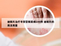 迪银片治疗寻常型银屑病100例 迪银片的用法用量