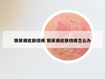银屑病皮肤烧痒 银屑病皮肤烧痒怎么办