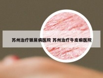 苏州治疗银屑病医院 苏州治疗牛皮癣医院