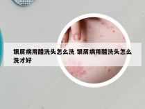 银屑病用醋洗头怎么洗 银屑病用醋洗头怎么洗才好