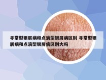 寻常型银屑病和点滴型银屑病区别 寻常型银屑病和点滴型银屑病区别大吗