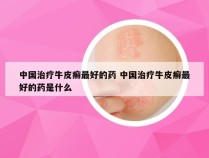中国治疗牛皮癣最好的药 中国治疗牛皮癣最好的药是什么