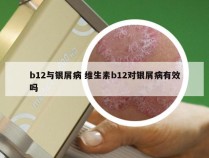 b12与银屑病 维生素b12对银屑病有效吗