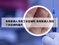 有银屑病人发烧了会犯病吗 有银屑病人发烧了会犯病吗图片