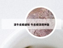 清牛皮癣通知 牛皮癣清理神器