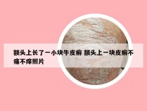 额头上长了一小块牛皮癣 额头上一块皮癣不痛不痒照片