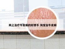 网上治疗牛皮癣的好使不 淘宝治牛皮癣