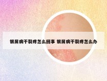 银屑病干裂疼怎么回事 银屑病干裂疼怎么办