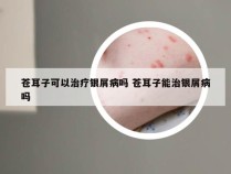 苍耳子可以治疗银屑病吗 苍耳子能治银屑病吗