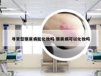 寻常型银屑病能化妆吗 银屑病可以化妆吗