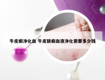 牛皮癣净化血 牛皮肤癣血液净化需要多少钱