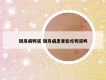 银屑病鸭蛋 银屑病患者能吃鸭蛋吗