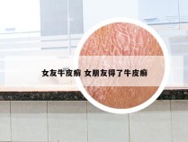 女友牛皮癣 女朋友得了牛皮癣