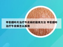 甲氨蝶呤片治疗牛皮癣的服用方法 甲氨蝶呤治疗牛皮癣怎么服用