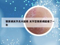 银屑病关节炎大腿根 关节型银屑病腿痛了一年