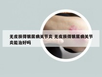 无皮损得银屑病关节炎 无皮损得银屑病关节炎能治好吗