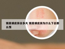 银屑病皮损会多大 银屑病皮损为什么下去那么慢