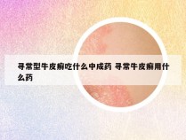 寻常型牛皮癣吃什么中成药 寻常牛皮癣用什么药