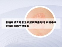 利福平和青霉素治银屑病效果好吗 利福平跟利福霉素哪个效果好