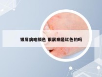银屑病啥颜色 银屑病是红色的吗