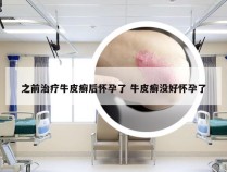 之前治疗牛皮癣后怀孕了 牛皮癣没好怀孕了