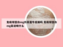 免疫球蛋白mg升高是牛皮癣吗 免疫球蛋白mg高说明什么