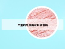 严重的牛皮癣可以输液吗