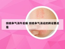 核桃承气汤牛皮癣 核桃承气汤证的辨证要点是
