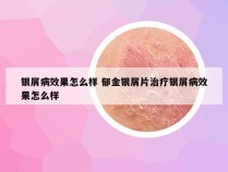 银屑病效果怎么样 郁金银屑片治疗银屑病效果怎么样