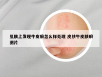 肌肤上发现牛皮癣怎么样处理 皮肤牛皮肤癣图片