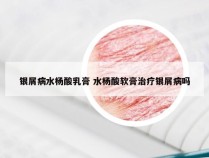 银屑病水杨酸乳膏 水杨酸软膏治疗银屑病吗
