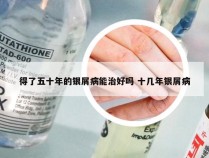 得了五十年的银屑病能治好吗 十几年银屑病