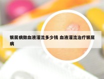 银屑病做血液灌流多少钱 血液灌流治疗银屑病