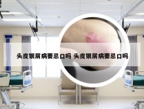 头皮银屑病要忌口吗 头皮银屑病要忌口吗