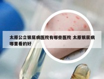 太原公立银屑病医院有哪些医院 太原银屑病哪里看的好