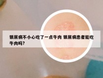 银屑病不小心吃了一点牛肉 银屑病患者能吃牛肉吗?
