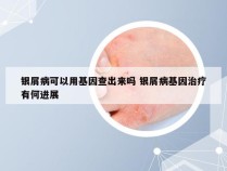 银屑病可以用基因查出来吗 银屑病基因治疗有何进展