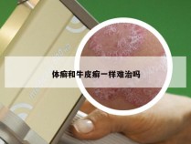 体癣和牛皮癣一样难治吗