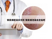 银屑病搓澡会怎样 银屑病泡澡自愈贴吧