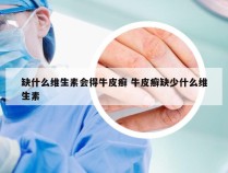 缺什么维生素会得牛皮癣 牛皮癣缺少什么维生素